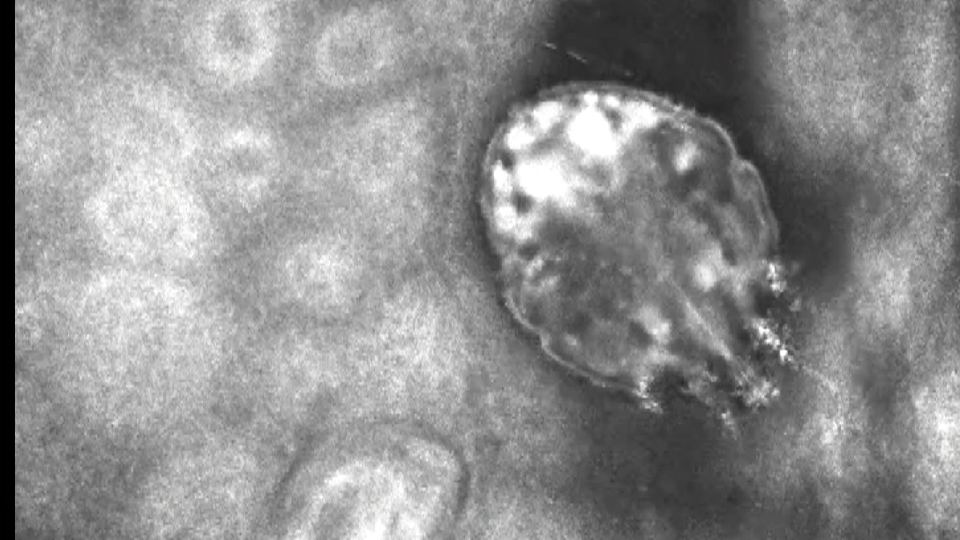 Dirençli uyuz salgını açıklaması!