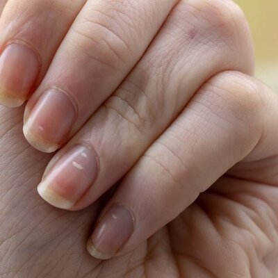 Tırnaklardaki bu çizgiler neyin belirtisi?