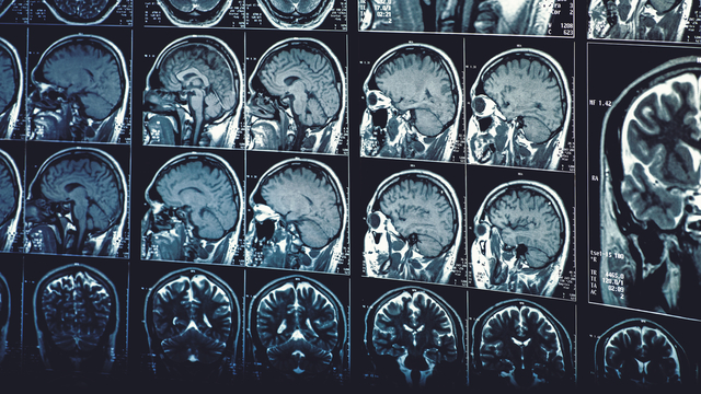 Alzheimer'ı yavaşlatıyor!