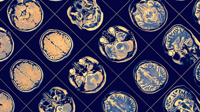 Uykuda bağırmak ve vurmak, Parkinson habercisi olabilir