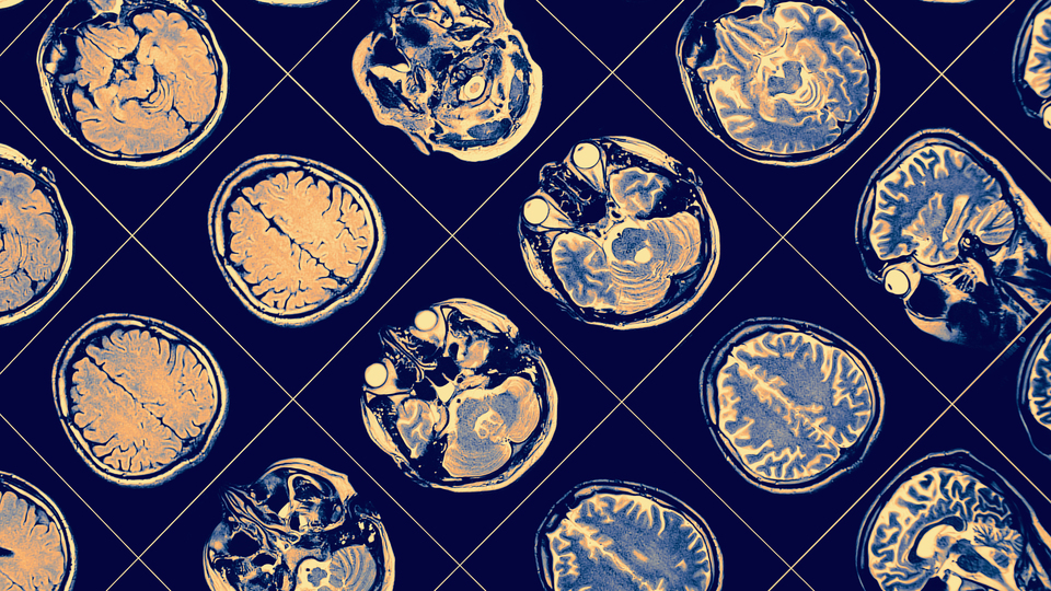 Uykuda bağırmak ve vurmak, Parkinson habercisi olabilir