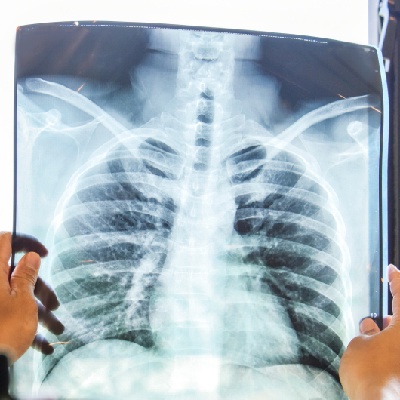 Akciğer kanserinin 8 önemli sinyaline dikkat!