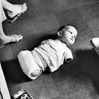 Çocukların eksik kol ve bacaklarla doğmasına neden olan ilaç faciası: Binlerce bebek böyle doğdu