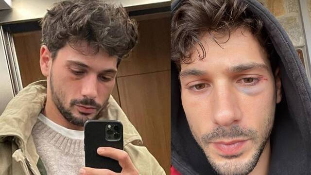 Gözüne darbe aldı: Güzelliklerle beraber dertleri de çektim