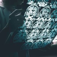 Alzheimer'ın belirtileri kan testiyle saptanacak