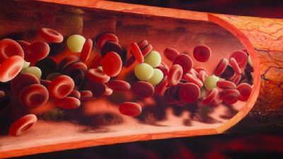 Bu belirtilere dikkat! Bacak damar tıkanıklığınız olabilir