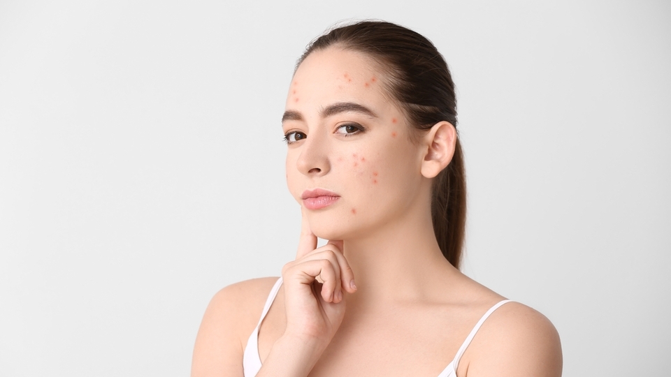 Karaciğer yağlanması sivilce yapar mı?