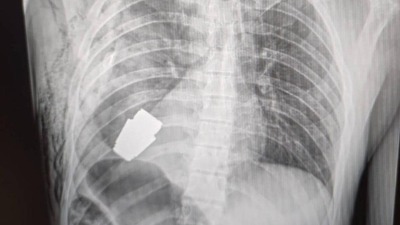 Ukraynalı askerin göğsünden patlamamış el bombası çıkarıldı