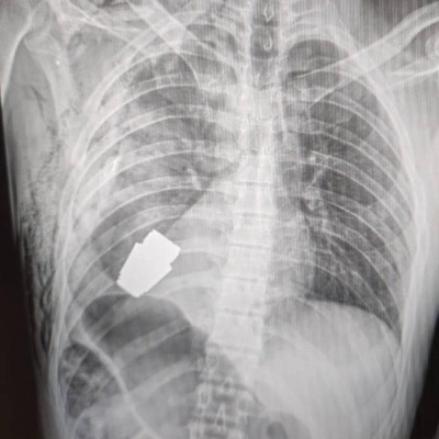 Ukraynalı askerin göğsünden patlamamış el bombası çıkarıldı