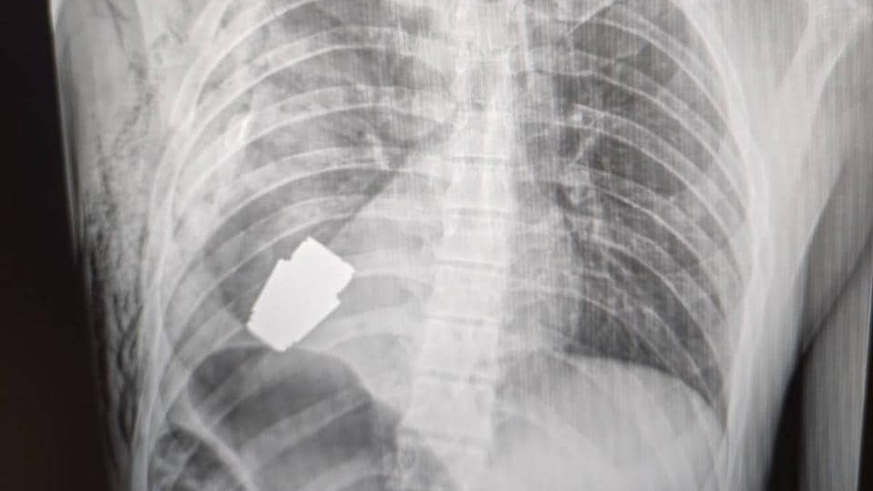 Ukraynalı askerin göğsünden patlamamış el bombası çıkarıldı