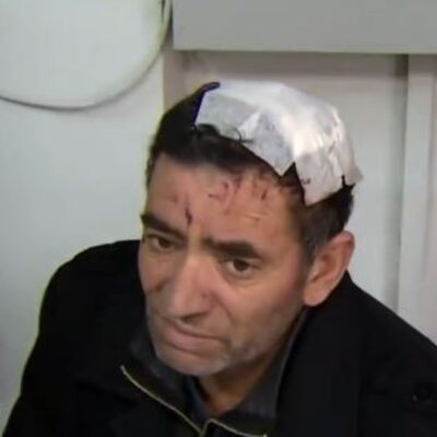 Miras için amcasının kafa derisini yüzdü!