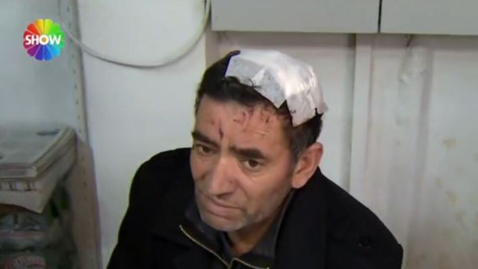 Miras için amcasının kafa derisini yüzdü!