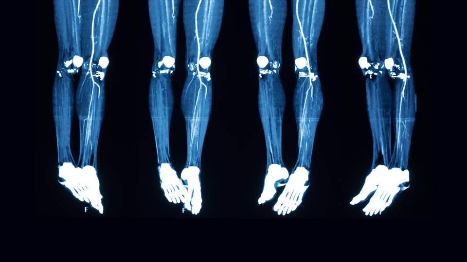 Buerger hastalığına bağlı uzuv kayıplarını önleyecek çalışma tıp literatürüne girdi