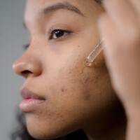 Yüzünüzdeki koyu lekelerden kurtulmanızı sağlayacak 3 basit yöntem