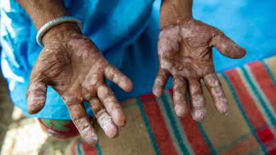 Tarihin en eski bulaşıcı hastalıklarından! Etkisini hala sürdürüyor