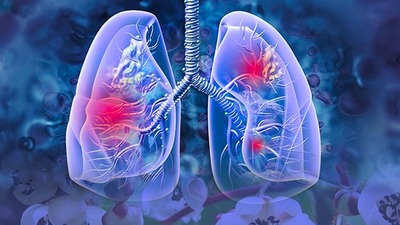 Japon araştırmacılar buldu: O meyve akciğer kanserinin oluşumunu engelleyebilir mi? 