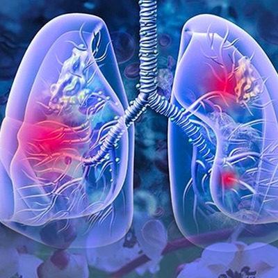 Japon araştırmacılar buldu: O meyve akciğer kanserinin oluşumunu engelleyebilir mi? 