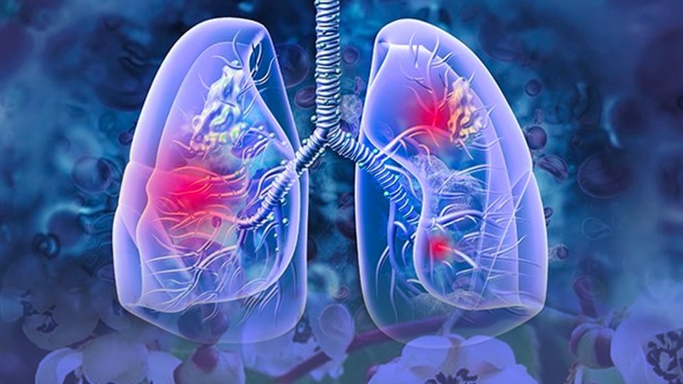 Japon araştırmacılar buldu: O meyve akciğer kanserinin oluşumunu engelleyebilir mi? 