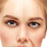 Göz kapağı ameliyatı sonrası dikkat edilmesi gerekenler