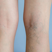 Varis ameliyatı sonrası dikkat edilmesi gerekenler