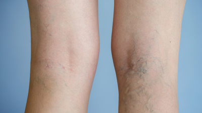 Varis ameliyatı sonrası dikkat edilmesi gerekenler