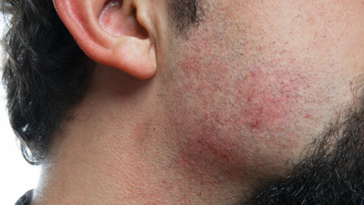 Kıl dönmesi ameliyatı sonrası dikkat edilmesi gerekenler