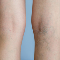 Varikosel ameliyatı sonrası dikkat edilmesi gerekenler