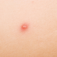 Çıban nasıl geçer?