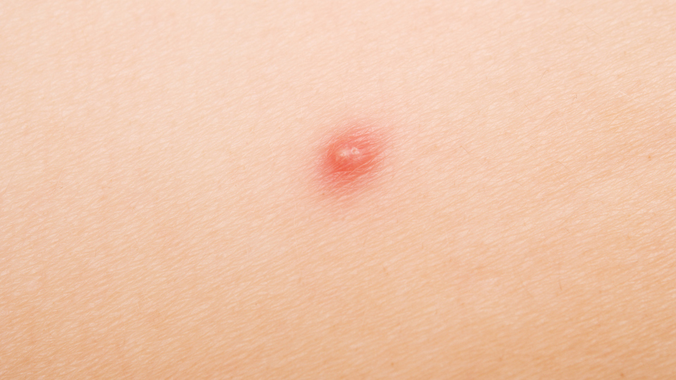 Çıban nasıl geçer?