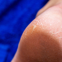 Ayaktaki nasır nasıl geçer?