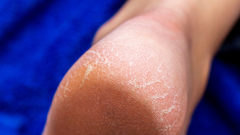 Ayaktaki nasır nasıl geçer?