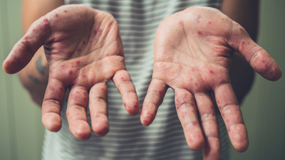 Klimik Başkanı Prof. Dr. Yavuz'dan kızamık salgını uyarısı