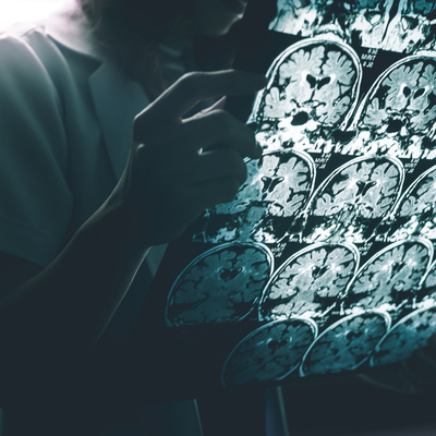 Alzheimer için tedavi umudu!