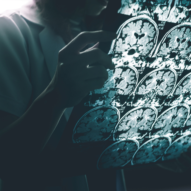 Alzheimer için tedavi umudu!