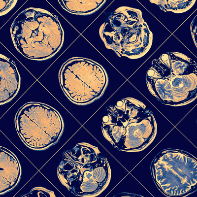 Parkinson'u daha erken teşhis edebilecek bir teknik geliştirildi