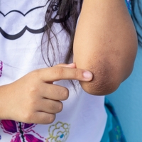 Dirsek ve koltuk altı kararması bu yöntemle 1 haftada yok oluyor!