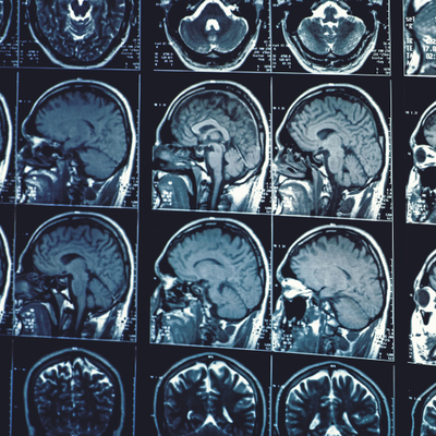 Demansı önlemeye yardımcı olacak şaşırtıcı derecede basit 19 yol!