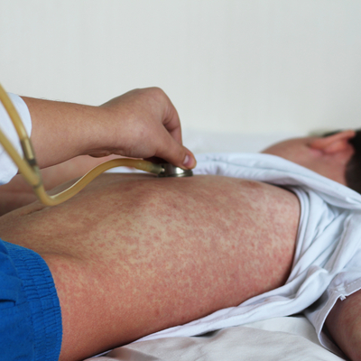 Doç. Dr. Kara'dan kızamıkta vaka artışına karşı aşı uyarısı!