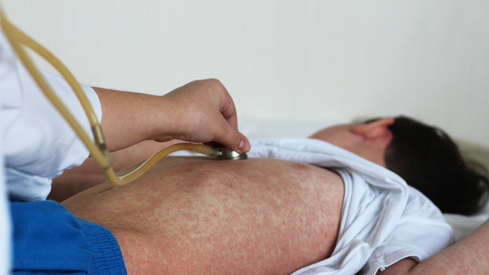 Doç. Dr. Kara'dan kızamıkta vaka artışına karşı aşı uyarısı!