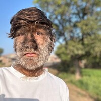 Kurt adam sendromlu Lalit Patel!