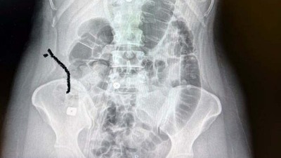 Boynuna takılan implant yemek borusunu yırtıp midesine düştü