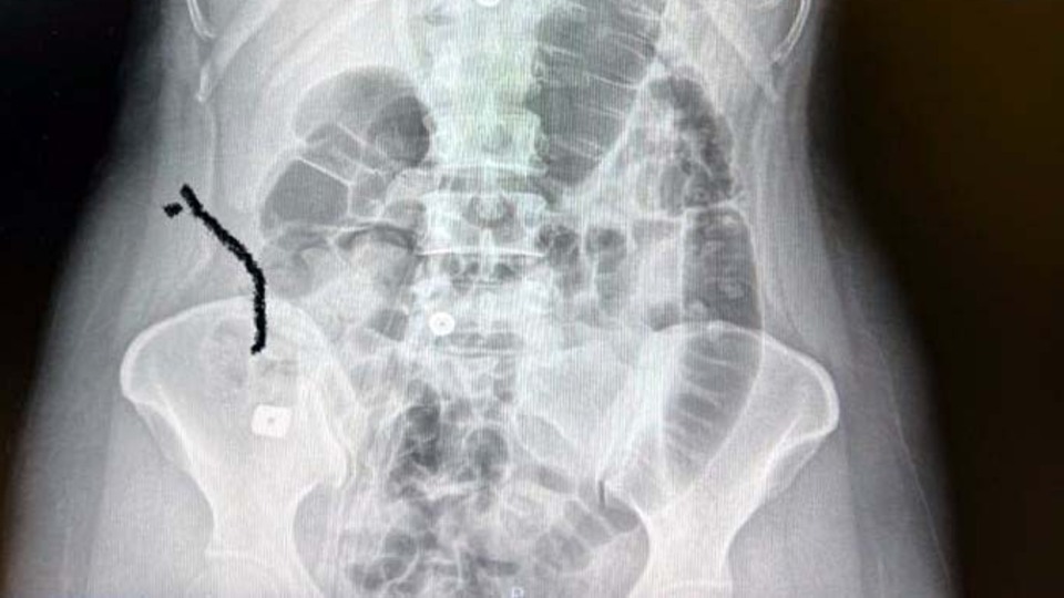 Boynuna takılan implant yemek borusunu yırtıp midesine düştü