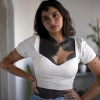 Vücudunu kaplayan bir doğum lekesiyle doğdu