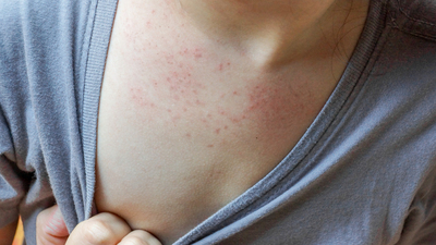 Kızamık vakalarının artması salgın olarak nitelenebilir mi?