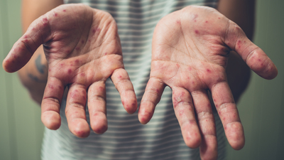 Kızamık vakalarında artış korkutuyor!