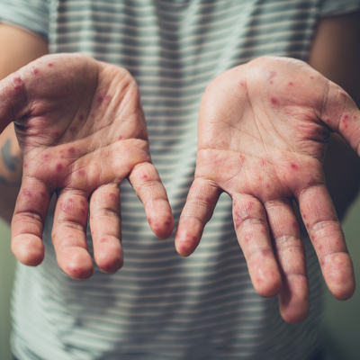 Kızamık vakalarında artış korkutuyor!