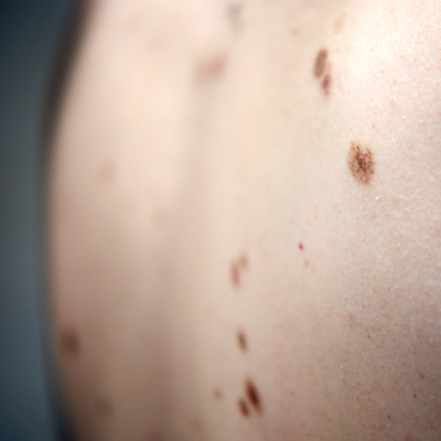 İklim değişikliği bunu da tetikledi! Prof. Özkan: Haftada 3-4 cilt kanseri vakası görüyoruz