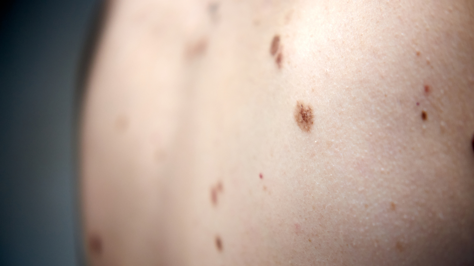 İklim değişikliği bunu da tetikledi! Prof. Özkan: Haftada 3-4 cilt kanseri vakası görüyoruz