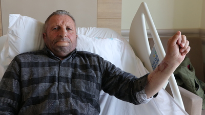 Kol derisinden dudak yapıldı