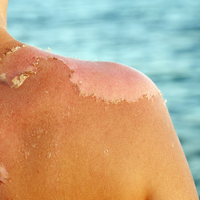 Güneş yanıklarına ne iyi gelir?